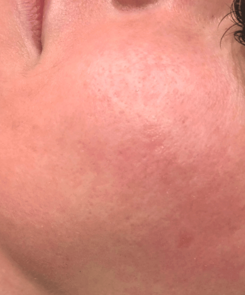 Microneedling-Patient 1-after