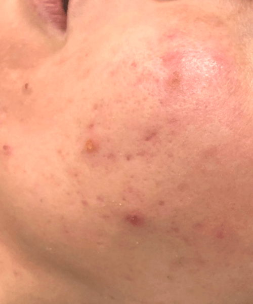 Microneedling-Patient 1-before