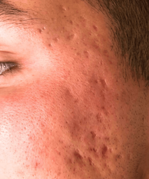 Microneedling-Patient 2 - Before