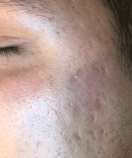 Microneedling-Patient 2- after