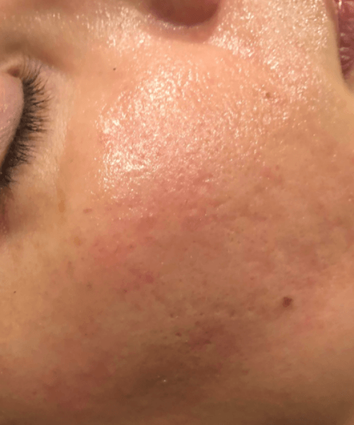 Microneedling-Patient 3- After