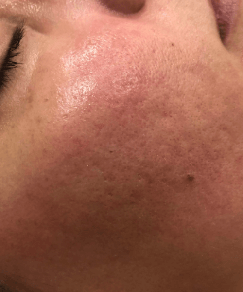 Microneedling-Patient 3- Before